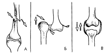 Виды повреждения 
костей: А – перелом; Б – вывих; В – растяжение связок